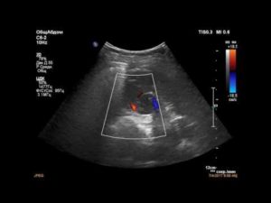 Ангиолипома левой почки мкб 10