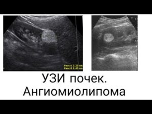 Ангиолипома левой почки мкб 10
