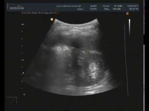 Ангиолипома левой почки мкб 10