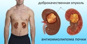 Ангиолипома левой почки мкб 10