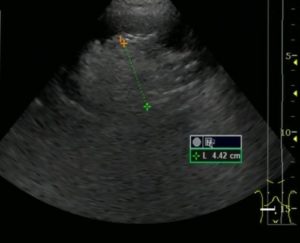 Ангиолипома левой почки мкб 10