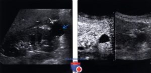 Арбуз при кисте почки