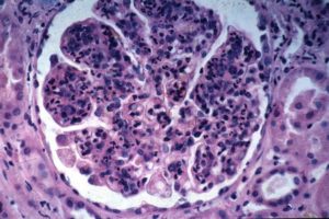 Аутоиммунный гломерулонефрит прогноз