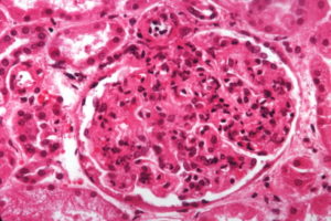 Аутоиммунный гломерулонефрит прогноз