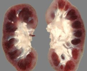 Аутоиммунный гломерулонефрит прогноз