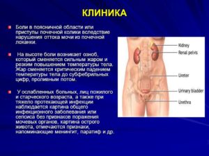 Боль в области почки справа при нажатии