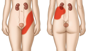 Боль в области почки справа при нажатии