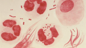 Боли и кровотечение при мочеиспускании