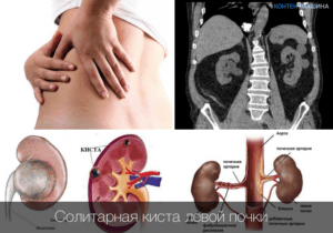 Боли при кисте почки лечение