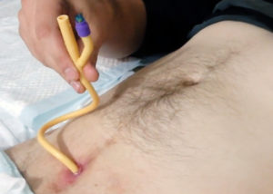 Больно ли ставить катетер