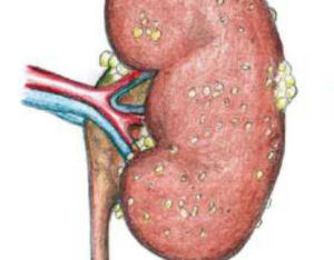 Болят почки от фурагина