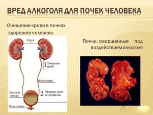 Болят почки после пива лечение