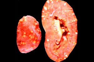 Бывает температура при воспалении почек