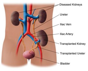 Человек с тремя почками