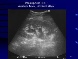 Члс почек не расширена что это значит