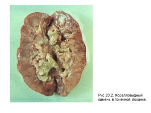 Что делать когда пошел камень в почках
