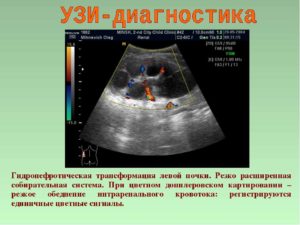 Что такое гидронефротическая трансформация левой почки