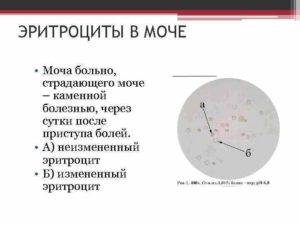 Что значит эритроциты в моче единичные