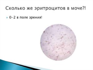 Что значит эритроциты в моче единичные