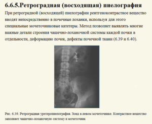 Деформация члс почек