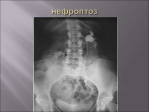 Диагностика нефроптоза почек