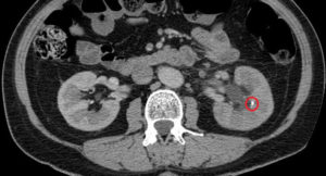 Диффузные изменения структур почечных синусов почек