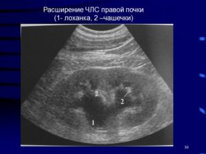 Дилатация члс почки что это такое