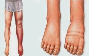 Если отказали почки шансы