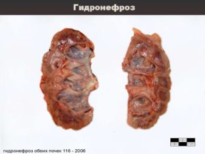 Гидронефроз 1 степени при беременности лечение