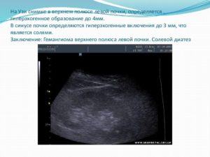 Гиперэхогенное образование в почке 4 мм