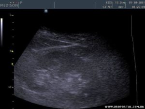Гиперэхогенное образование в почке 4 мм