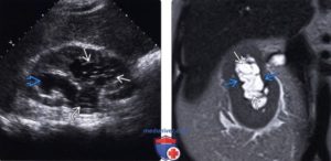 Гиперэхогенное образование в почке 4 мм