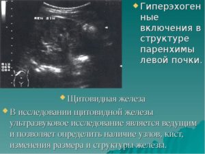 Гиперэхогенное образование в почке 4 мм