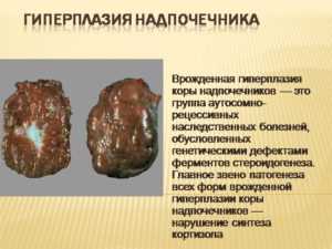 Гиперплазия коры надпочечников