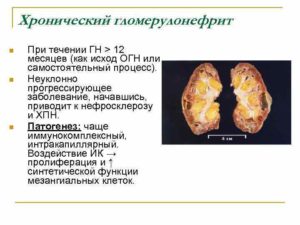 Гломерулонефрит почек что это такое исход заболевания