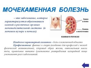 Как лечить мочекаменную болезнь у мужчин в домашних условиях