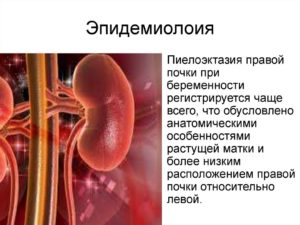 Как лечить пиелокаликоэктазия почки