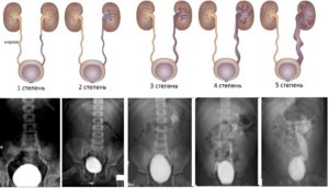 Как лечить рефлюкс почек у детей