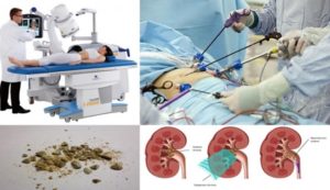 Как оперируют камни в почках