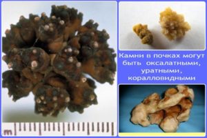 Как проверить если камни в почках