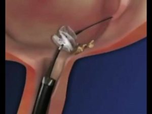 Как убрать камни из почек без операции