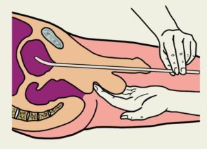 Как вставляется в почку катетер