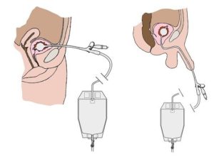 Как вставляется в почку катетер