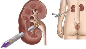 Камень в почке у мужчины что делать