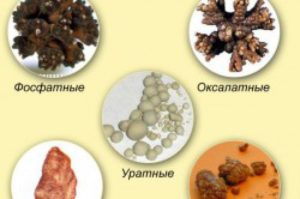 Камни в почках лечение таблетками разбивающие