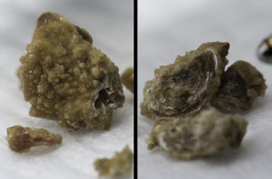 Камни в почках лечение таблетками разбивающие