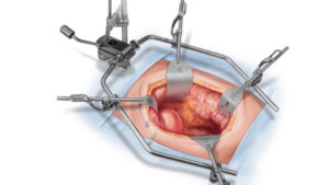 Камни в почках операция полостная операция