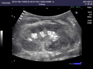 Камни в почках узи покажет