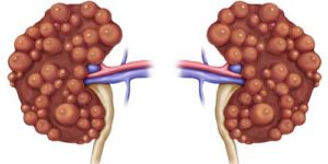 Киста почки может ли болеть