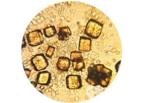 Кристаллы мочевой кислоты в почках